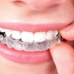 Tips And Tricks For A Better Invisalign Experience