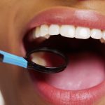 Dental Crowns- Addressing Dental Problems with Dentures