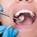 Dental Implants Vs. Veneers: Which Is The Best Option For Replacing Missing Teeth?