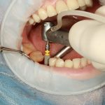 What Types of Dental Implants Can You Find in Tarzana?