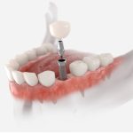 Five Reasons You Should Get A Dental Implant