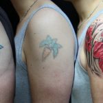 How much does tattoo removal cost?