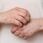 Banishing Scabies for Good: How Permethrin Cream Can Be Your Game-Changer