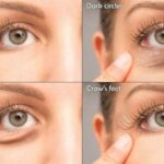 Understanding the Causes of Dark Circles and Their Advanced Treatment Options