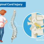 The Common Ways A Person Could Sustain A Spinal Cord Injury