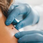 Skin Tags: Why They Develop and How to Remove Them