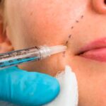 How to Choose the Right Dermal Filler for Your Wrinkles