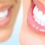 The Role of Veneers in a Complete Smile Makeover