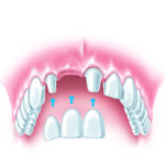 What Are My Options for Replacing Missing Teeth?