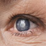 How To Determine Whether You Have Cataracts