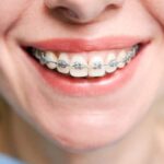 Teeth Straightening for Adults: Overcoming the Stigma