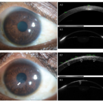 Post-Treatment Care After Corneal Scar Surgery for a Complete Recovery