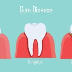 Understanding the Stages of Gum Disease