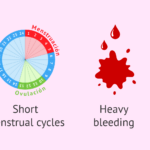 What Are the Risks of Endometriosis?