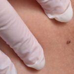 What to Know Before Removing Skin Tags