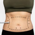 The Benefits of Liposuction Beyond Weight Loss