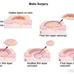 What Is Mohs Surgery and How Does it Work?