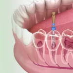 How Root Canal Treatment Can Save Your Tooth and Your Smile