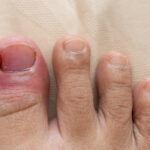 Ingrown Toenail Treatment: Professional Care vs. Home Remedies