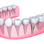 How Dental Implants Restore More Than Just Your Smile