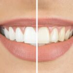 How Teeth Whitening Can Improve Your Smile