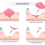 What Is Mohs Surgery and How Does it Work?