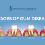 Understanding the Stages of Gum Disease