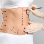 FaceTite, Liposuction And Morpheus8 In Sydney | Complete Face And Body Rejuvenation